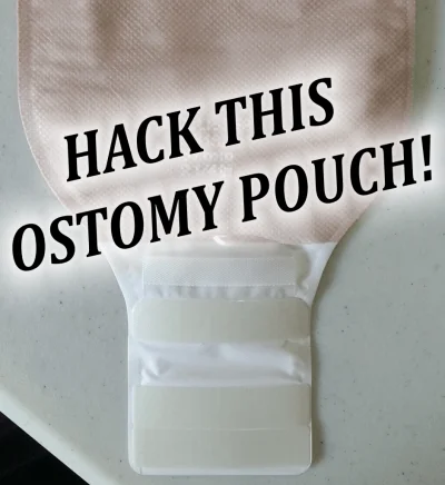 Hollister Ostomy Pouch Hack - OSTOMY TIP (w/ video)