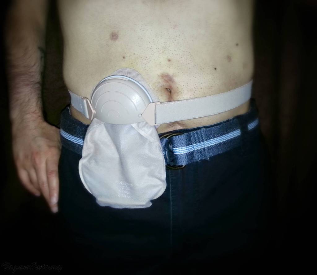 Ostomy Accessories Guide: Stoma Guards 