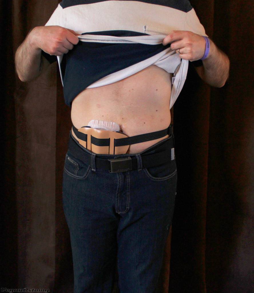 Dressing with an Ostomy: A Clothing Guide for Men