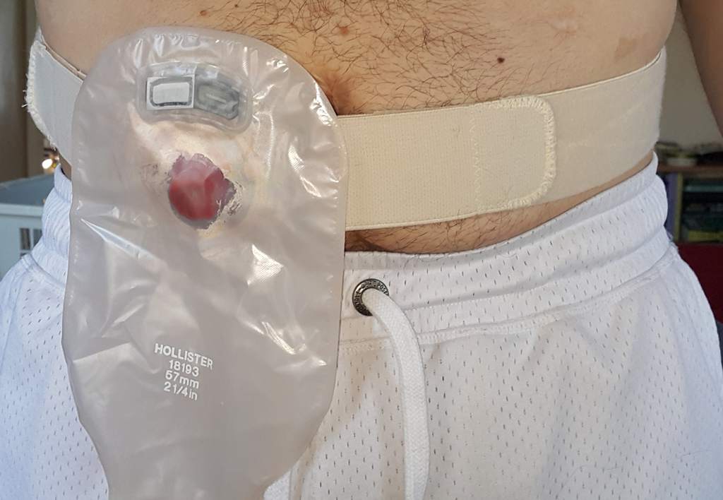 A properly fitting stoma bag with stoma adhesives is essential for
