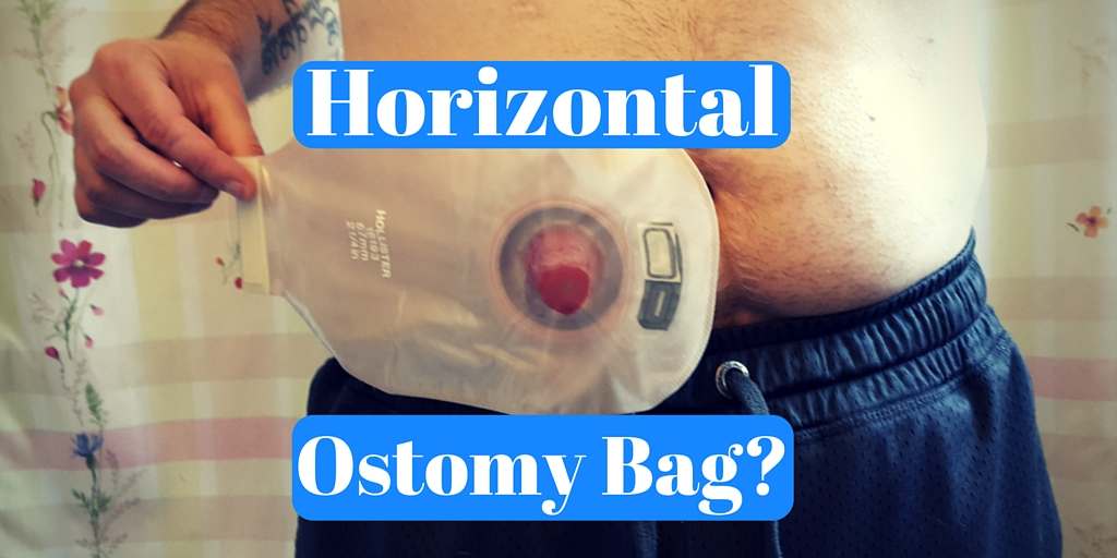 Sticking of the ConvaTec one-piece ostomy bag over the right-sided stoma.