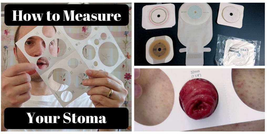 How to Measure Your Stoma: Ostomy Tips